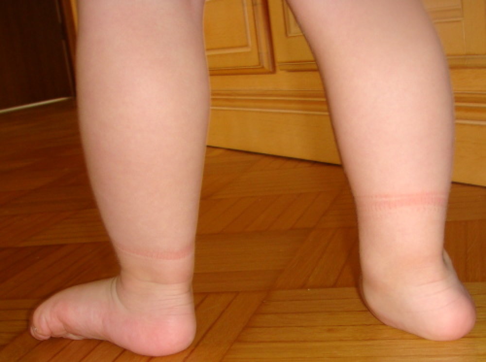 Knick-Senkfuß Kleinkind , dječje stopala Knick-Senkfuß Kleinkind , dječje stopala