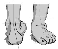 Knick-Senkfuß Knick-Senkfuß